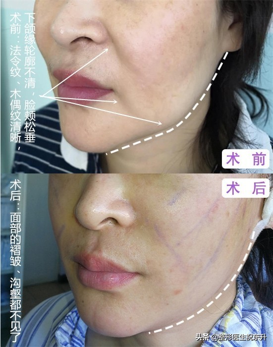 消除法令纹和嘴角纹最好的方法,法令纹怎么消除简单方法