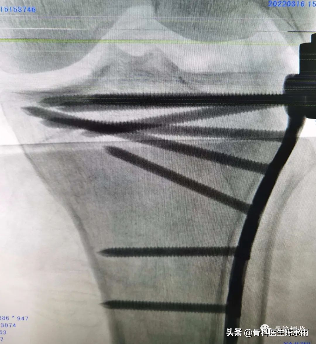 膝关节胫骨平台骨折,最近胫骨平台骨折视频