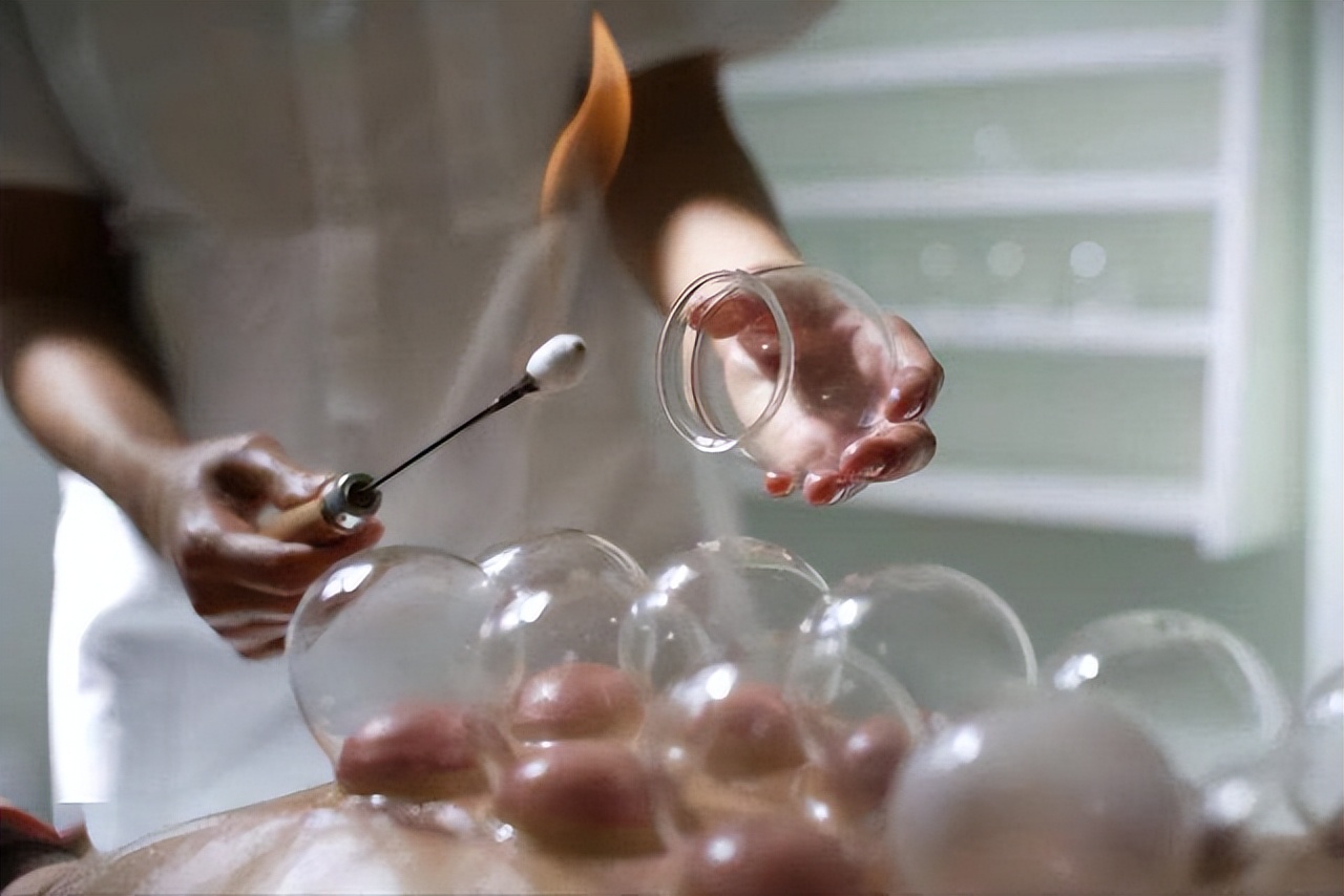 拔火罐吸出来的到底是什么,拔火罐时吸出的淤血是毒素吗