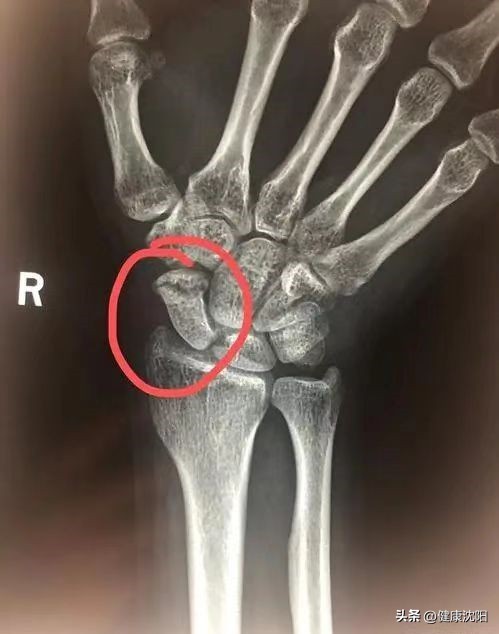 手腕摔伤后能活动是否骨折,手腕摔伤怎么辨别骨折还是扭伤