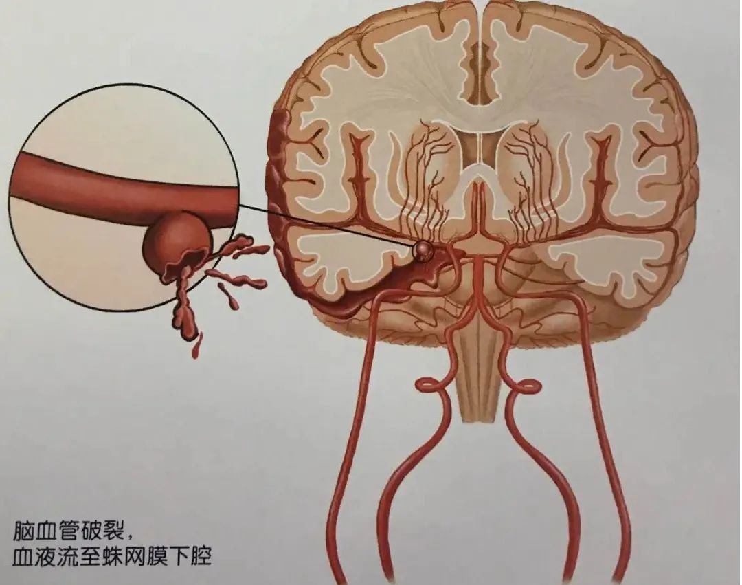 动脉瘤蛛网膜下腔出血术后并发症,动脉瘤导致蛛网膜下腔出血严重吗