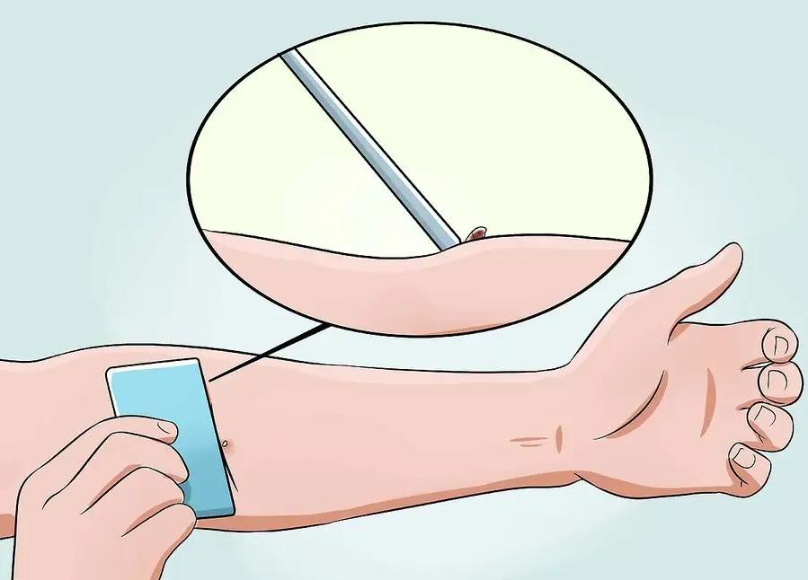 蜂蜇伤如何处理,蜂蜇伤最佳处理方法