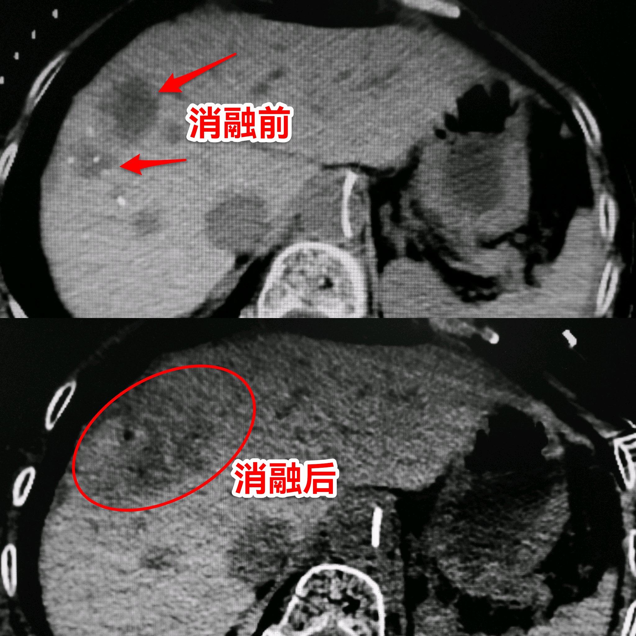 肠癌肝转移先做化疗还是介入,肠癌肝转移介入治疗哪里做得好