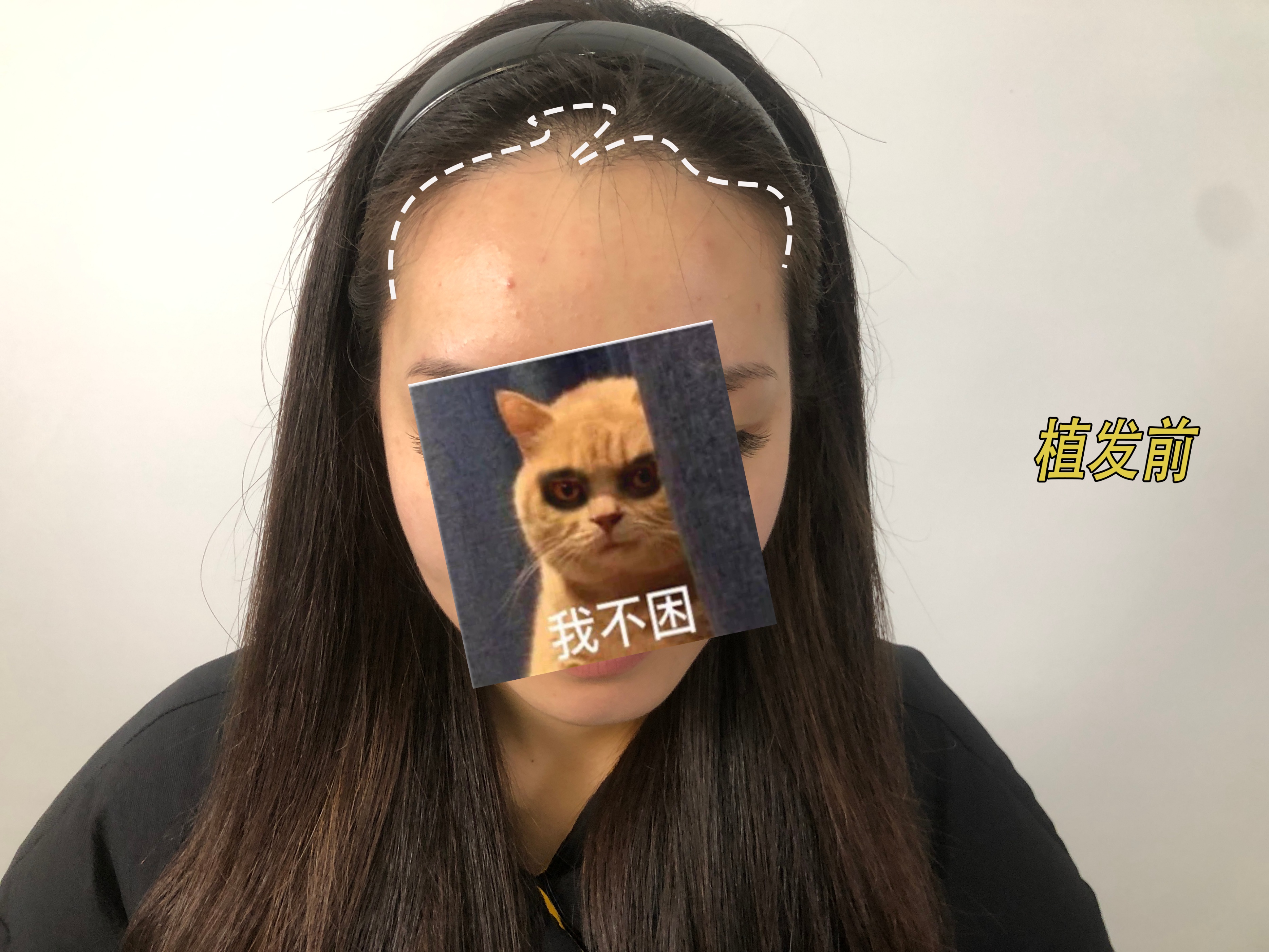 恒美植发后续,恒美植发靠谱不