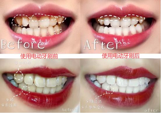 电动牙刷对牙齿有伤害吗？博主披露四大伤牙原因