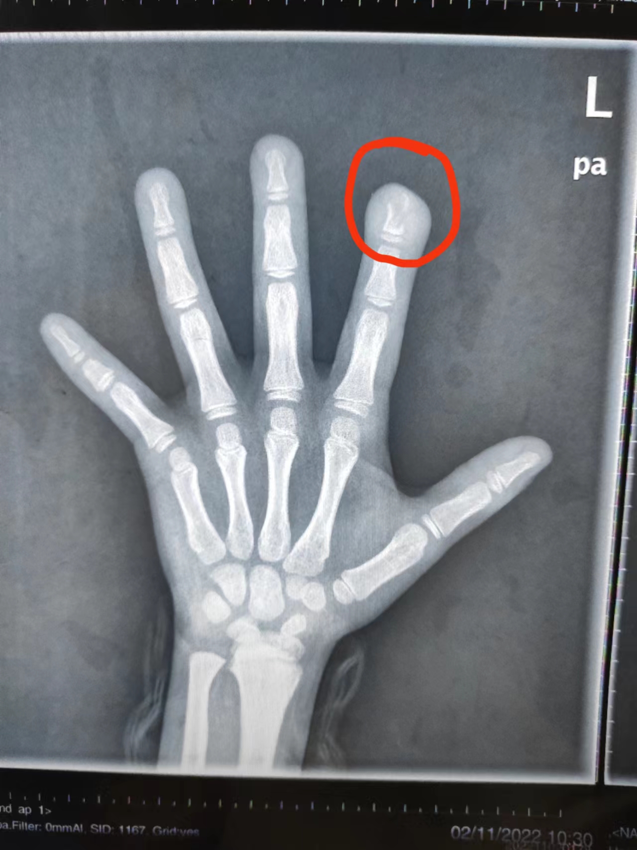 9岁女孩长期啃咬指甲成骨髓炎,男孩啃秃指甲引发骨髓炎