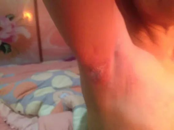 带状疱疹后遗神经痛针灸治疗方法,舒卿针灸治疗带状疱疹后遗神经痛