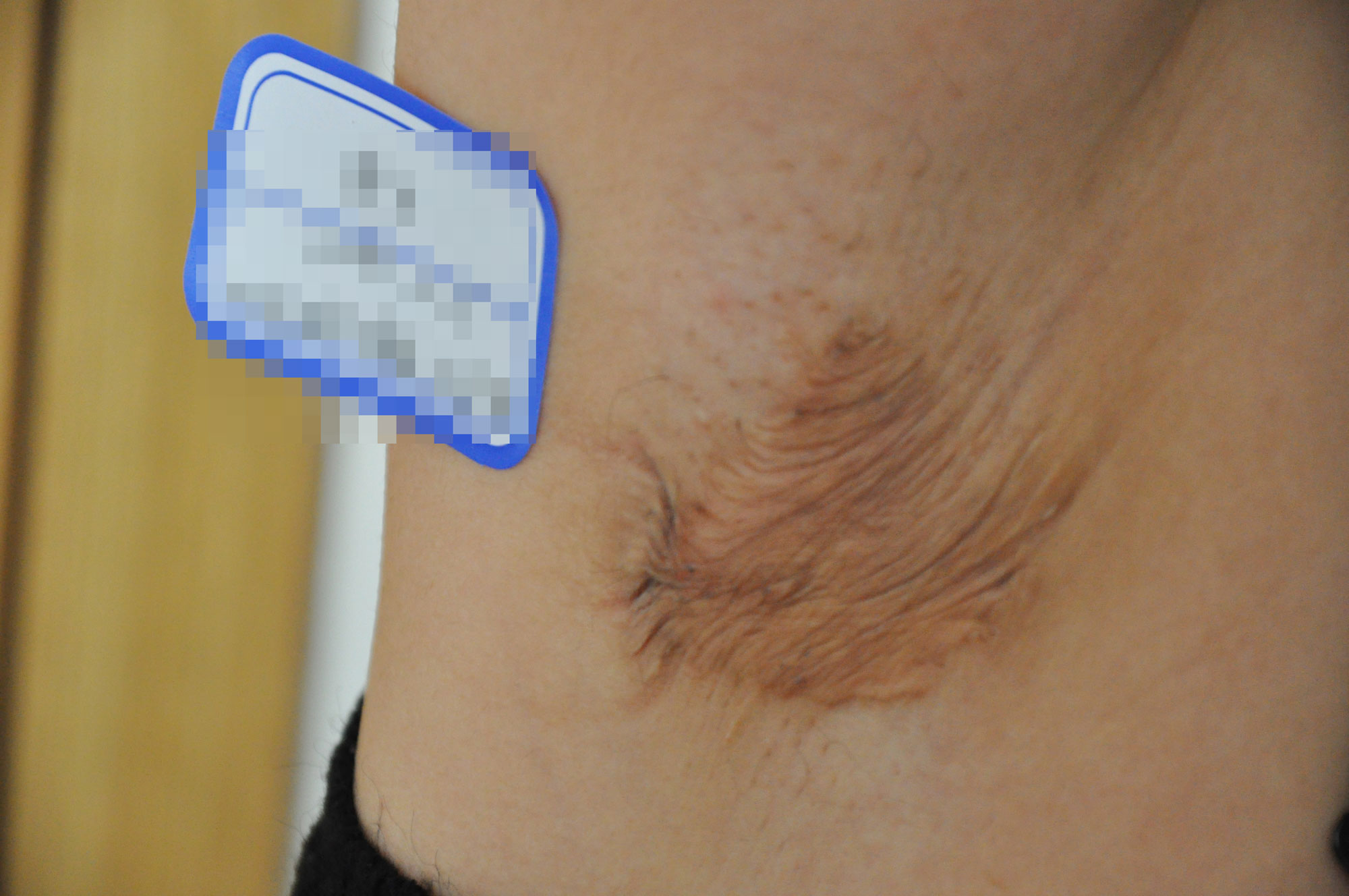 郑州第二中医院皮肤科张子春,郑州市第二中医院治疗疤痕案例