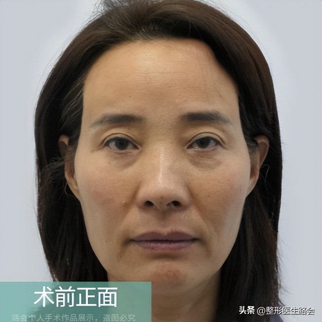 年龄大面部塌陷,年龄大皮肤松弛怎么办