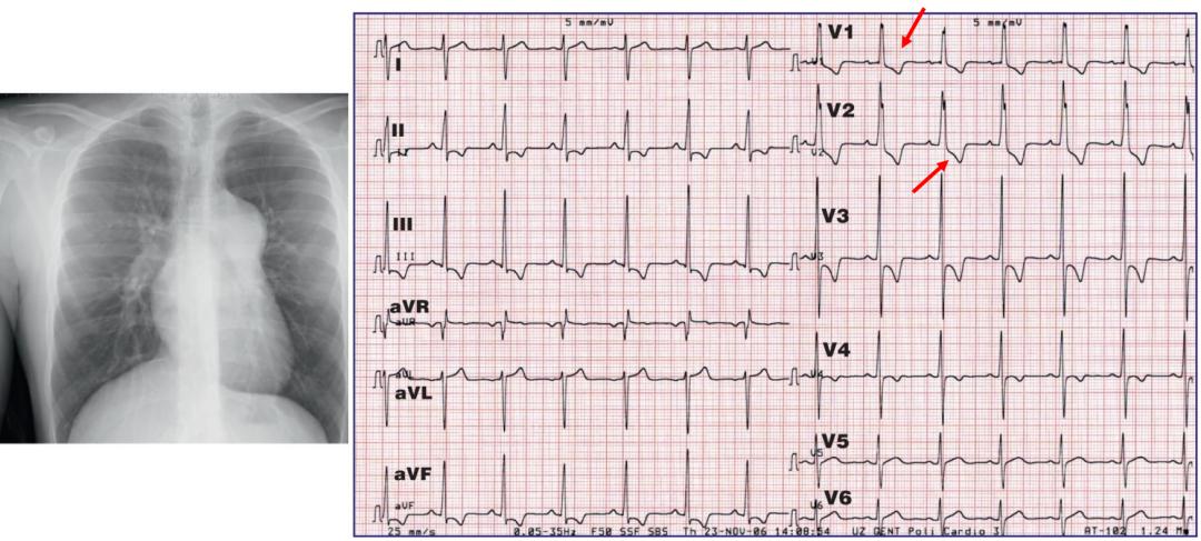 心电图笔记26：QRS波振幅变高，需要想到哪些