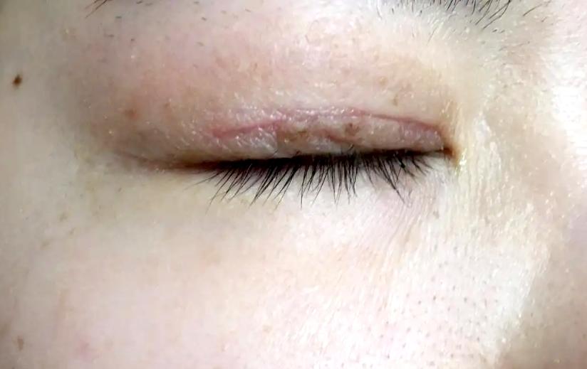 术后出现疤痕增生怎么办?正确选择祛疤药膏,让疤痕变淡变小