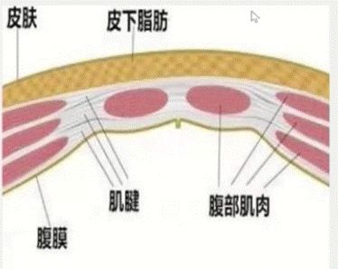 产后腹直肌恢复了肚子还突出,腹直肌分离肚子太松垮