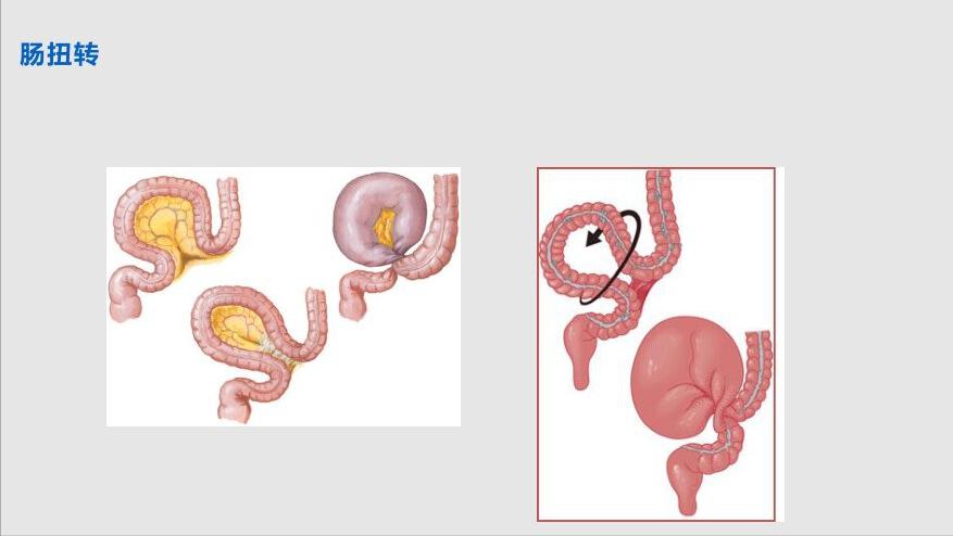 肚子疼检查说肠子堵住了,肚子疼像肠子扭在一起怎么回事