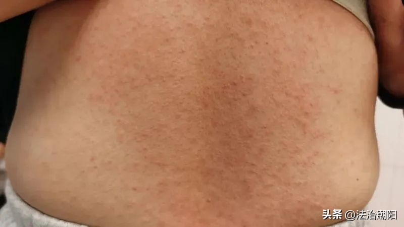 女子混吃7种药物致过敏,女子混吃七种感冒药毁容