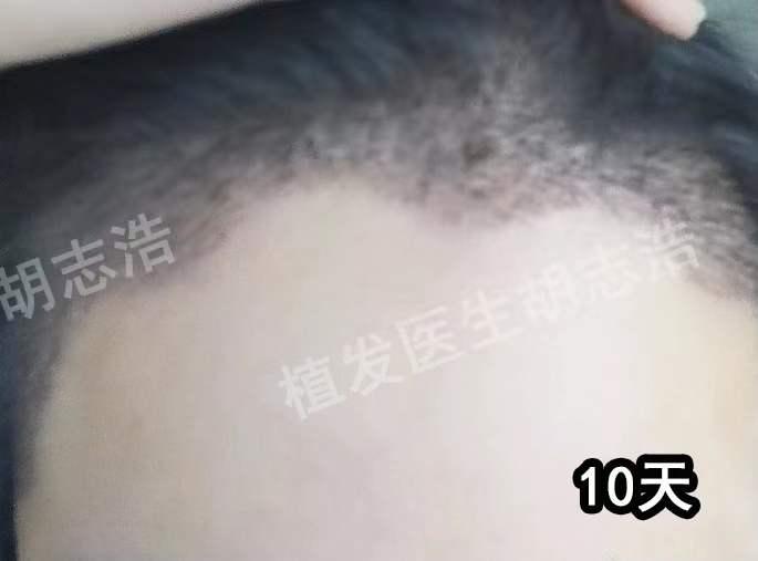 植发手术后恢复全过程,植发手术全过程详解