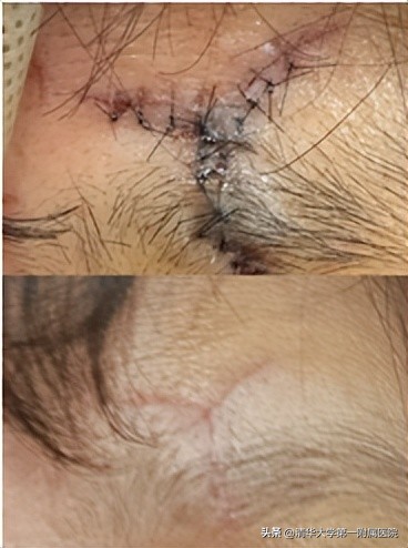 额头磕伤了伤口发白怎么办,额头碰伤出现血印怎么处理