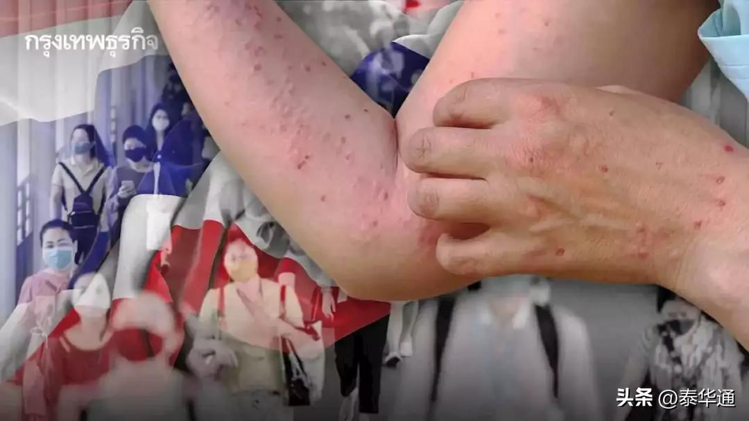 泰国15岁男子感染艾滋病,泰国爆发猴痘