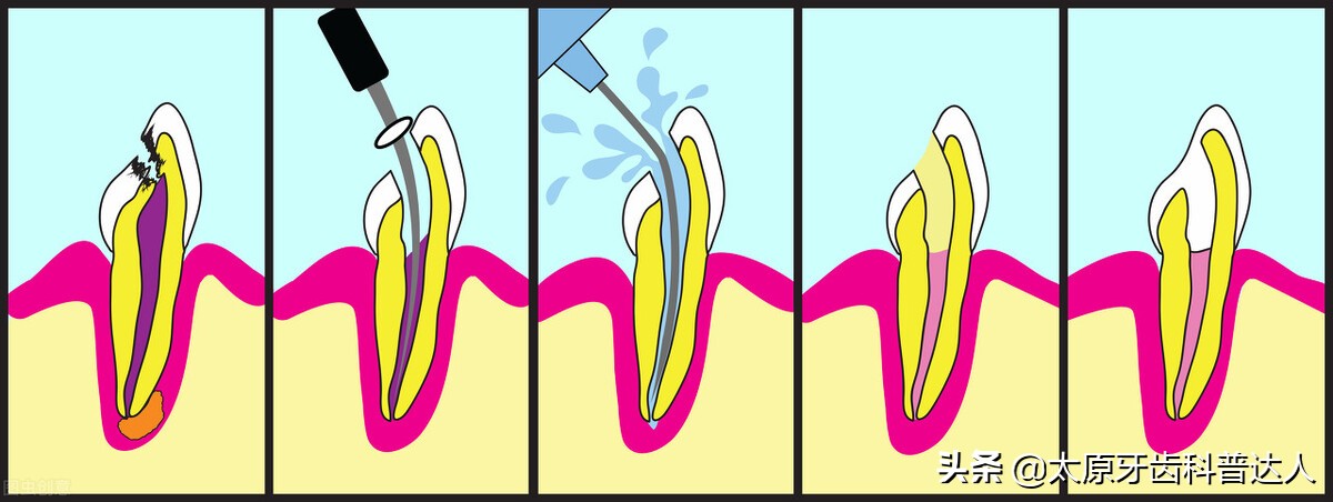 根管治疗做全瓷牙冠有必要吗,根管治疗后戴牙冠容易掉吗