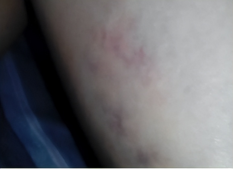 筋膜枪弊端危害曝光,筋膜枪有哪些副作用