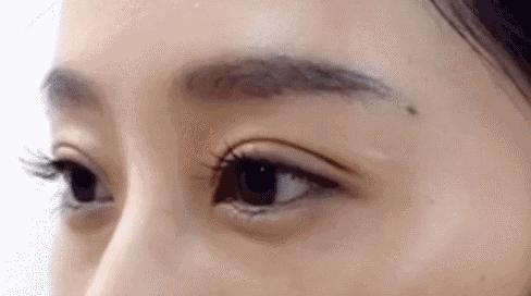 双眼皮修复宽改窄有肉条感,全切双眼皮出现肉条可以修复吗