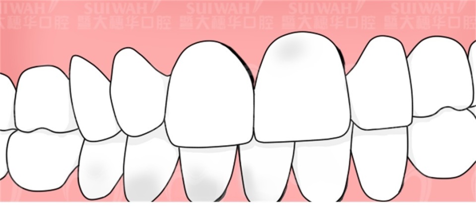 根管治疗后不戴牙套后坏掉了,根管治疗后不戴牙冠的后果