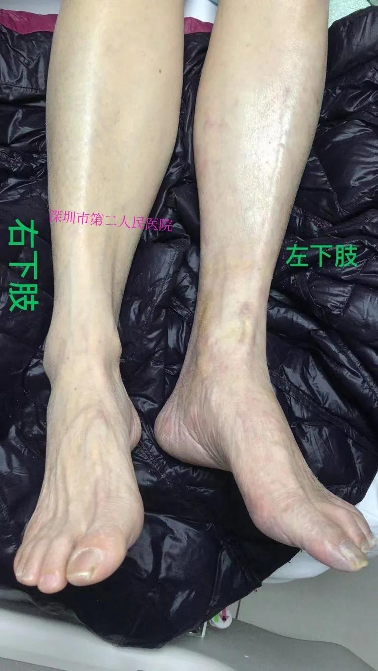 老年人小腿浮肿发紫什么原因,老人突然小腿发凉发软