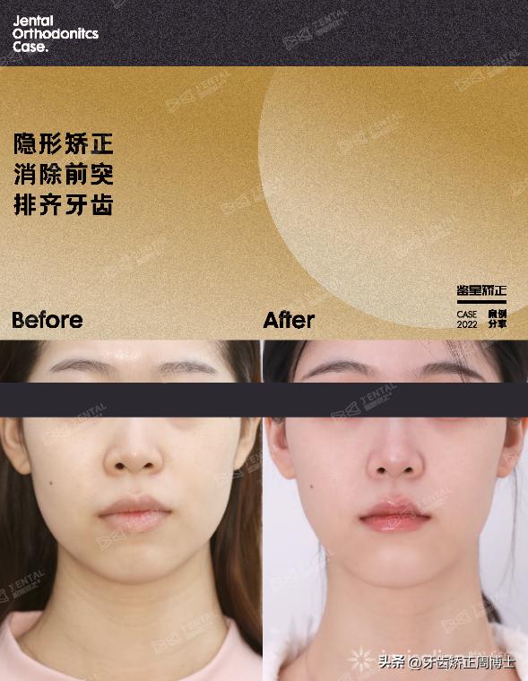 隐形矫正龅牙效果图,严重龅牙可以用隐形矫正吗