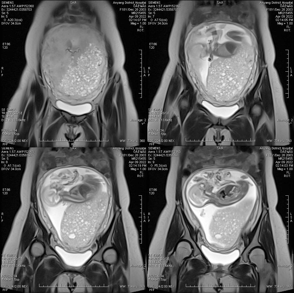 这么典型的葡萄胎MRI影像，快来学习吧