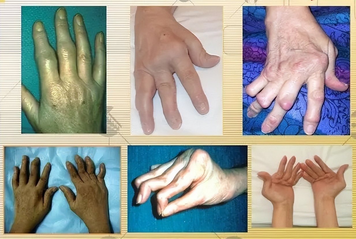 重庆市痛风专家高锋,高锋医生