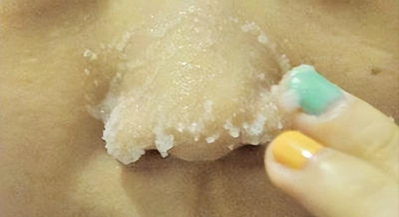 鼻子黑头里挤出的白色油脂怎么办,鼻子上有硬硬的黑头怎么办