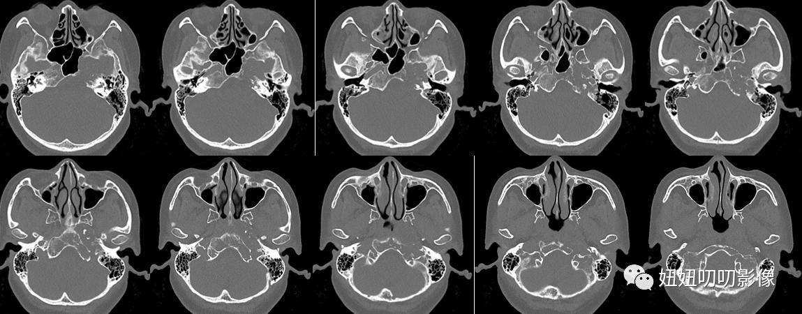 软骨肉瘤mri,骨肉瘤ctmr表现