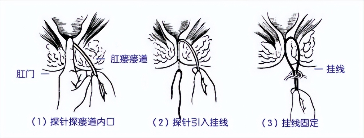 中医治疗肛瘘动画演示,肛瘘在中医上是湿热吗