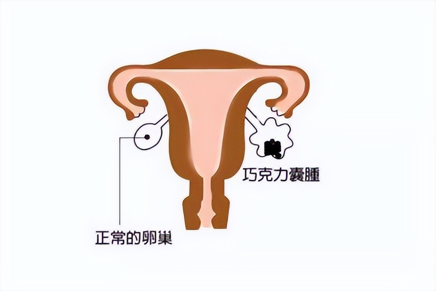 【健康小课堂】巧囊是什么病？