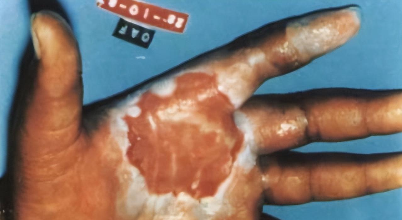 22岁女孩吃感冒药不幸离世,女子不幸中毒身亡