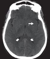 脑水肿的影像,脑水肿形成机制生理学