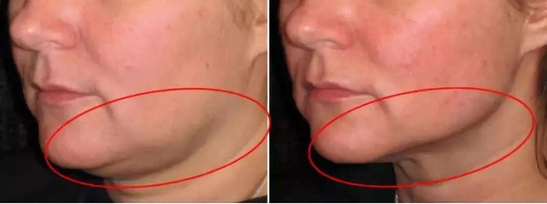 下颌黄金微雕恢复过程,正颌手术改善面中部凹陷