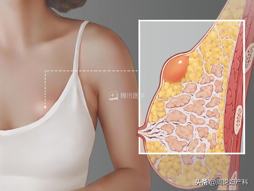 摸到乳房有肿块但是彩超显示正常,如果发现乳房肿块怎么办