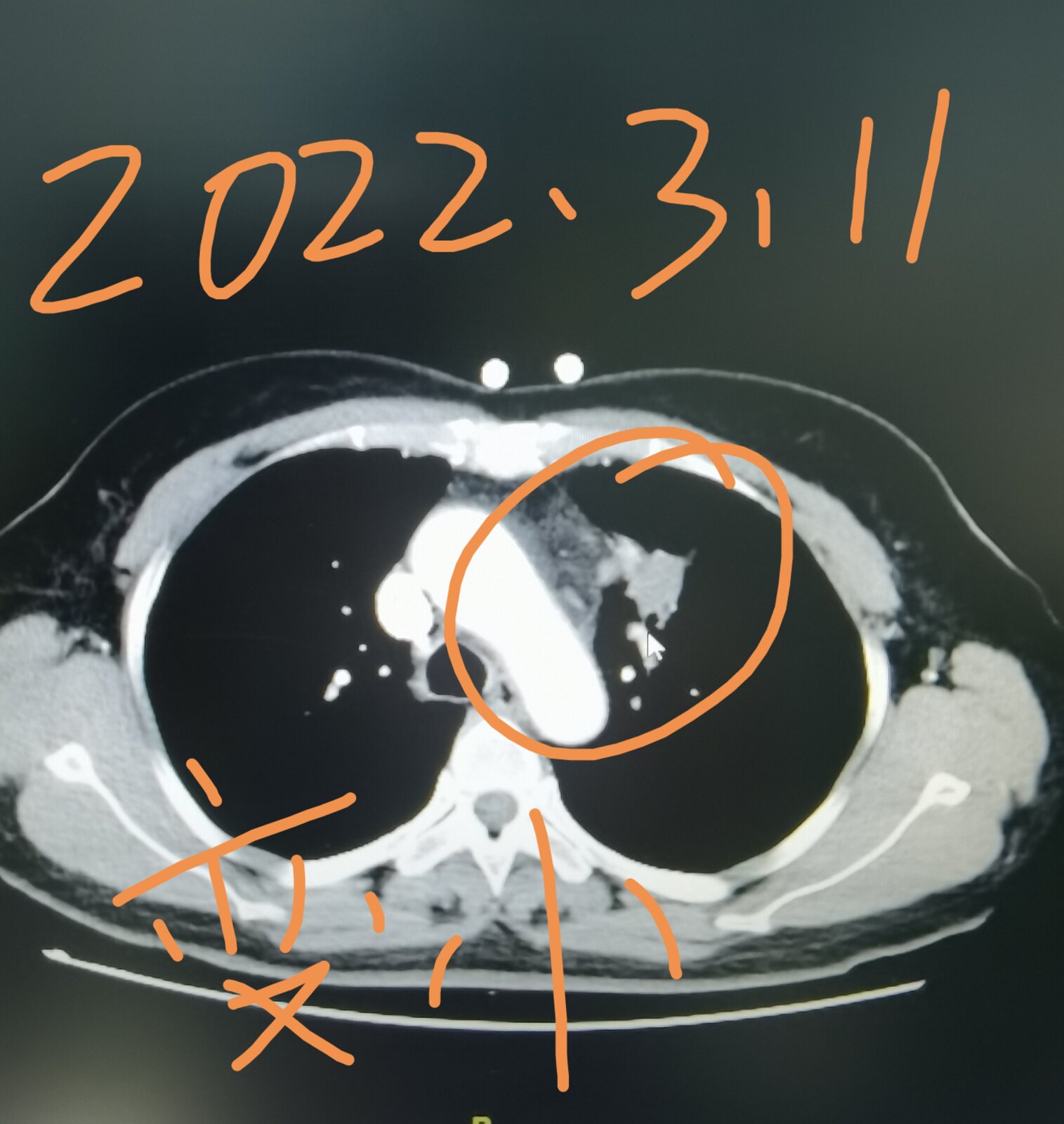 刘懿博士肺癌晚期症状,刘懿博士说肺癌微浸润复发