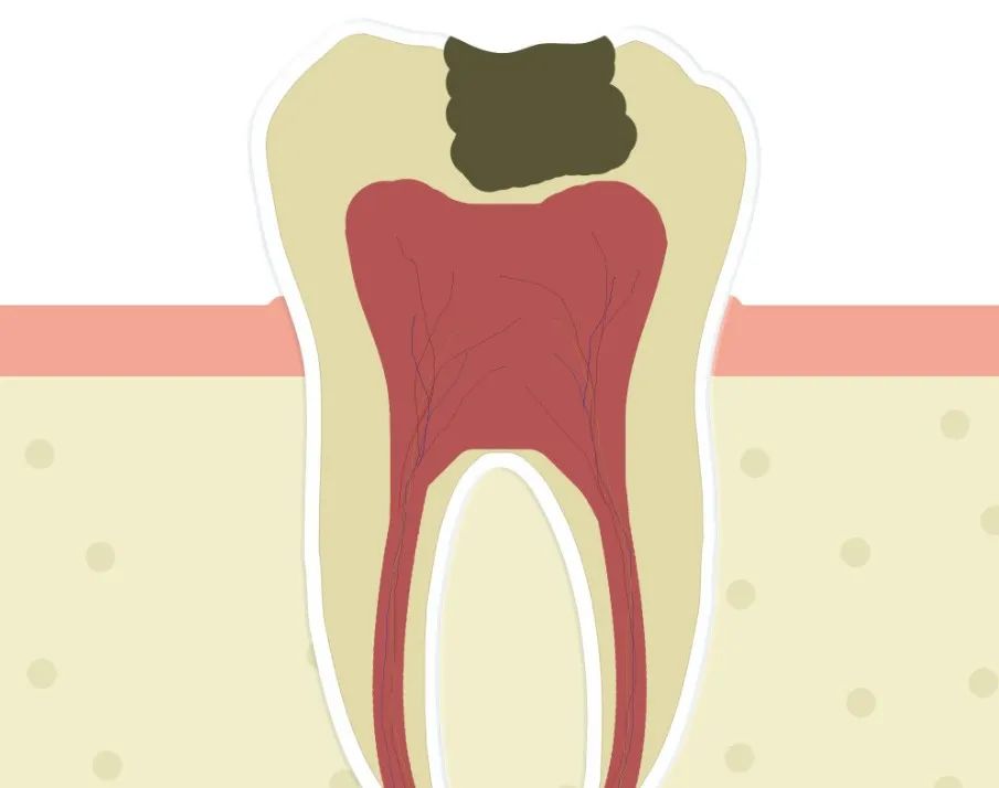 深龋补牙没垫底怎么办,补牙之前为什么要垫底
