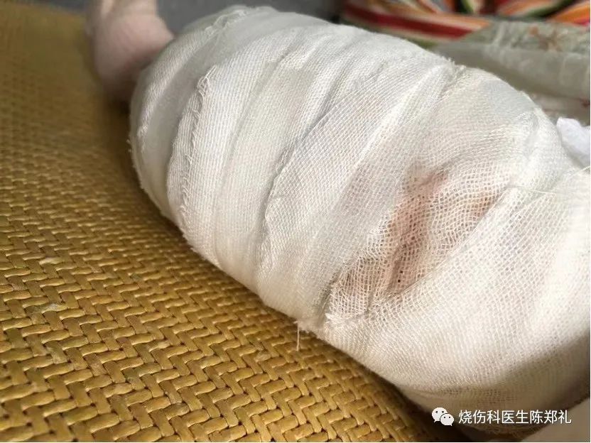 创面外用药物及敷料的使用策略及理论依据