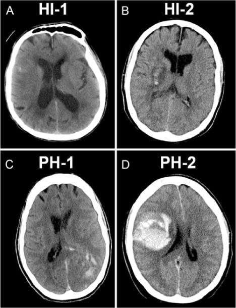 脑梗死与脑出血如何鉴别,脑梗死与脑出血怎样鉴别