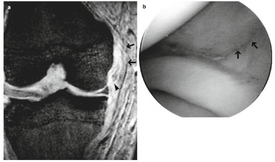 内侧副韧带损伤自测图,mcl内侧副韧带