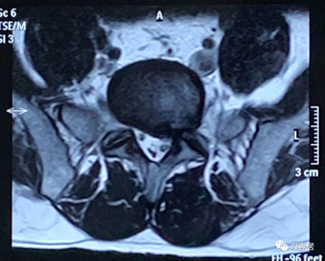 20岁腰5骶1椎间盘突出怎么办,腰5骶1椎间盘突出急性发作