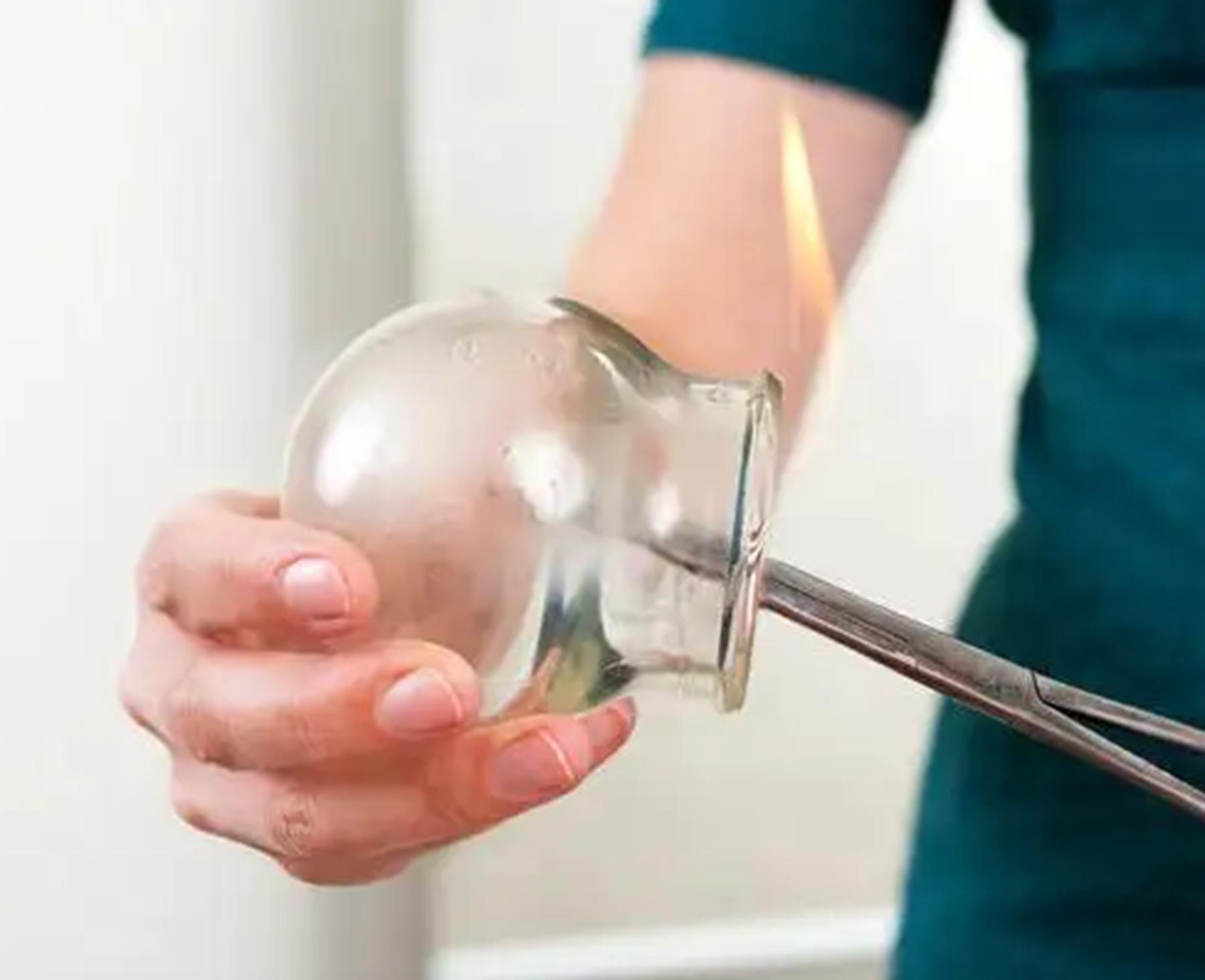 女子拔罐二度烧伤后续,女子拔火罐被烧伤后续