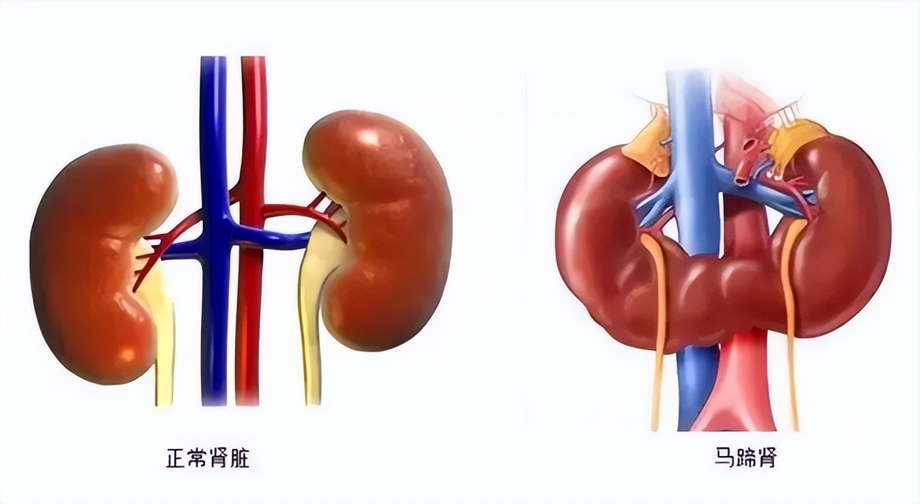 老人长肾结石,老人肾结石8cm严重吗