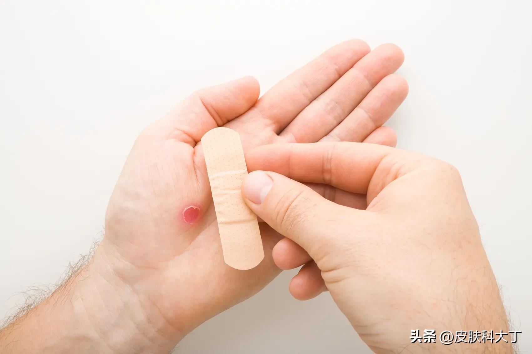 不慎感染HPV病毒长疙瘩，这种有效、价格便宜的治疗你一定要看看