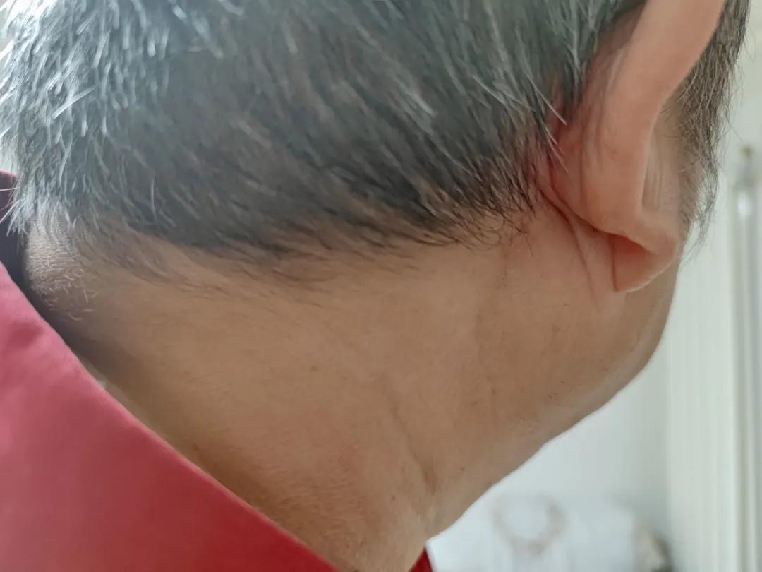 罕见眼病患者的绝望与挣扎,罕见失明的眼病