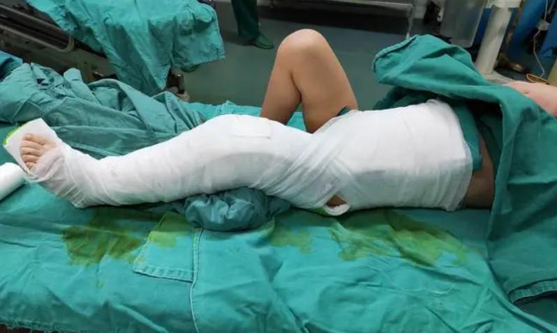 儿童股骨干粉碎性骨折对位不太好,儿童股骨干骨折石膏固定