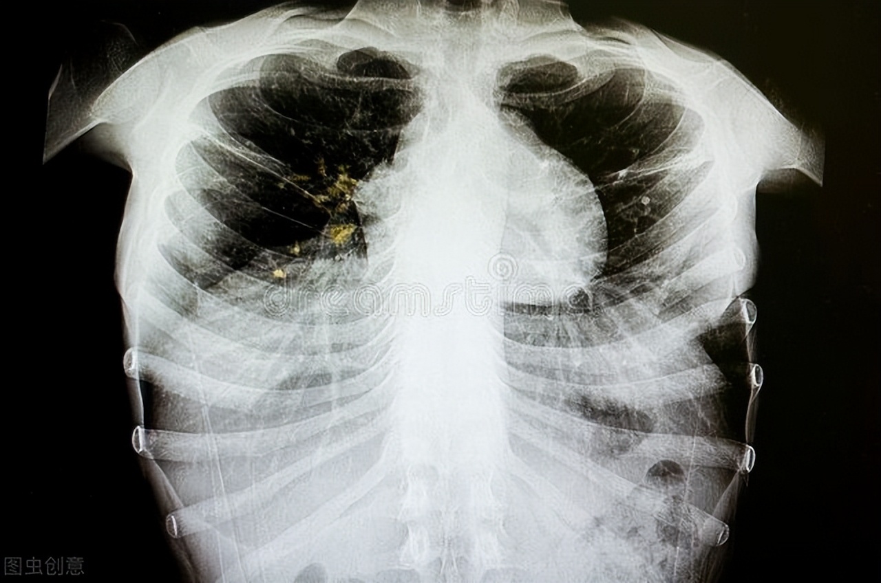 肺结核治疗的新方向！肠道微生物普雷沃菌与肺结核之间相关性研究