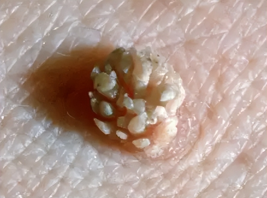 派特灵派特生物提醒｜身上的小疙瘩，有可能是尖锐湿疣